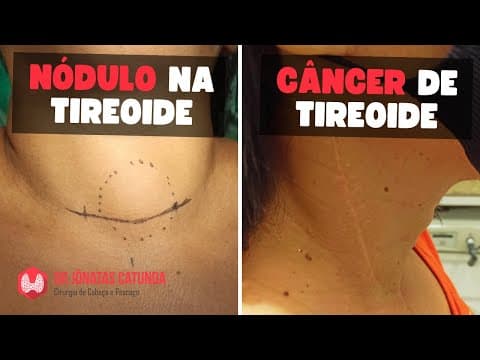 Nódulo na tireóide X Câncer de tireoide: entenda a diferença