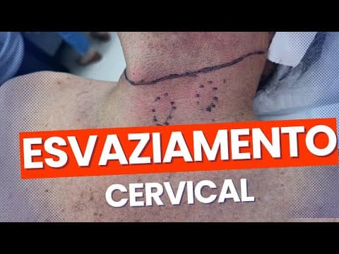Esvaziamento cervical no câncer de tireoide - indicações, riscos, complicações, recuperação!