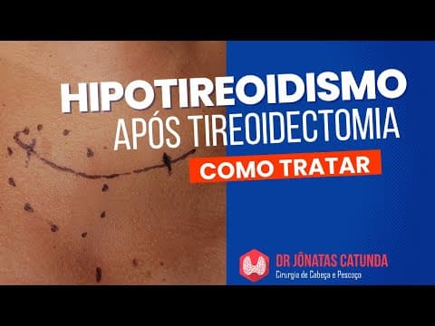 Vida Após a Tireoidectomia Total: Enfrentando o Hipotireoidismo