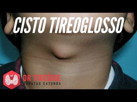 Cisto tireoglosso - doença que pode aparecer em crianças e adultos! | Dr Jônatas Catunda