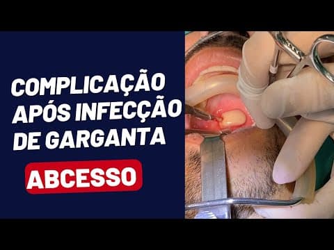 Complicação GRAVE de Infecção de Garganta - Abscesso Periamigdalino - Cirurgia