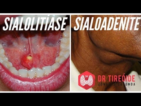 Sialolitíase e Sialoadenite | Dr Jônatas Catunda