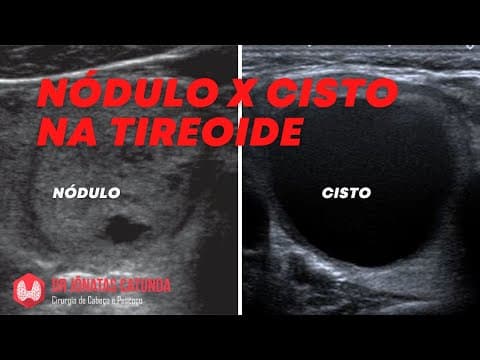 Nódulo e cisto na tireoide