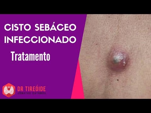 Cisto sebáceo infeccionado: drenagem e tratamento