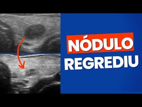 Nódulo na tireóide que regrediu de tamanho