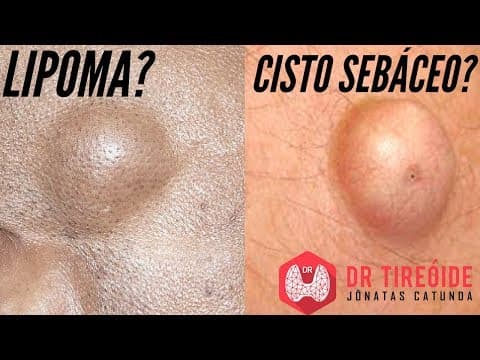 Lipoma? Cisto sebáceo? Saiba o que são e qual o tratamento! | Dr Jônatas Catunda