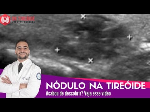 Nódulo na Tireóide - Vídeo para quem acabou de descobrir! | Dr Jônatas Catunda