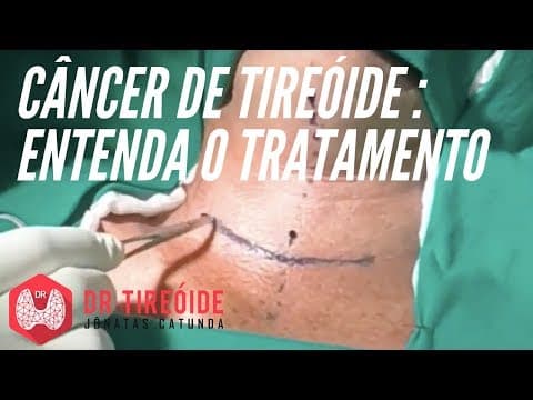 Tratamento do câncer de tireóide | Dr Jônatas Catunda