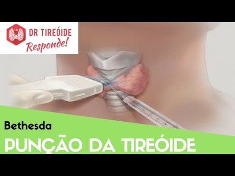 Punção da tireóide - Falando sobre o Bethesda - Dr Tireóide Responde