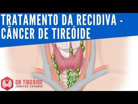 Tratamento da recidiva do câncer de tireóide | Dr Tireóide Responde