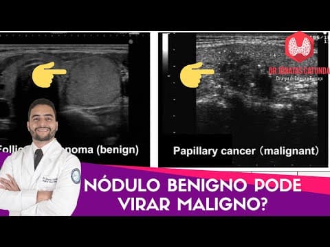 Nódulo na tireóide benigno pode virar maligno?