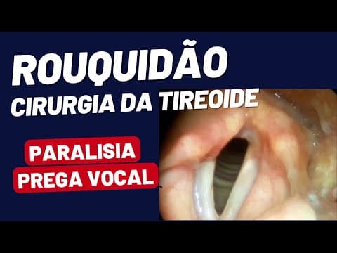 Paralisia de Prega Vocal após Tireoidectomia: O que a Laringoscopia Revela?