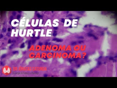 Células de Hurtle - Bethesda IV: Neoplasia folicular, adenoma ou carcinoma?