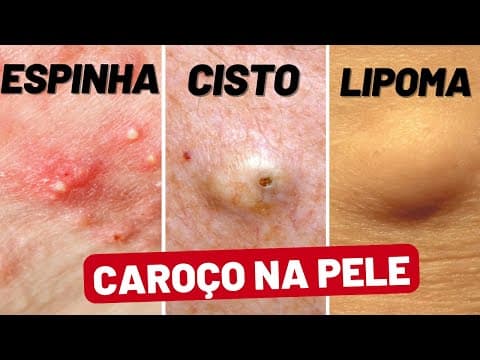 Caroço na pele: cisto, espinha ou lipoma?