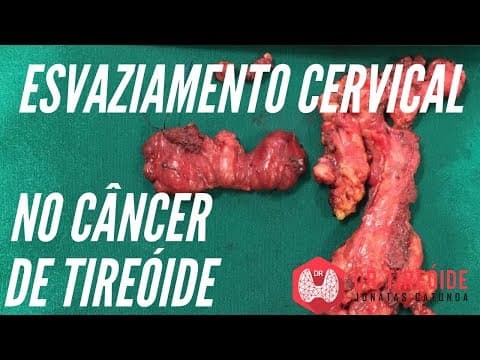 Esvaziamento cervical no câncer de tireóide | Dr Jônatas Catunda