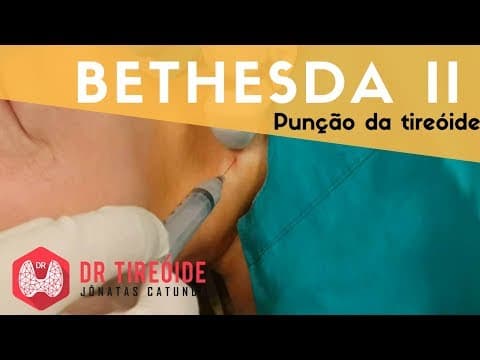 PAAF da tireóide Bethesda II - Resultado BENIGNO!!! | Dr Jônatas Catunda