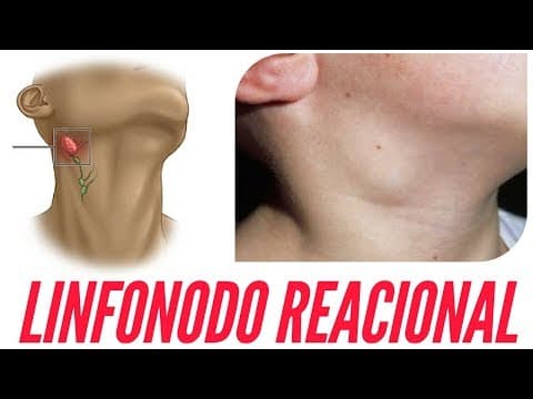 O que é linfonodo reacional? | Dr Jônatas Catunda