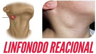 O que é linfonodo reacional? | Dr Jônatas Catunda