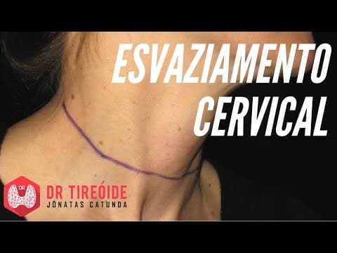 Esvaziamento Cervical | Dr Jônatas Catunda