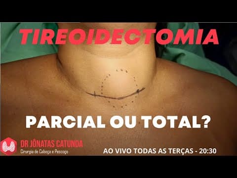 Tireoidectomia parcial ou total?