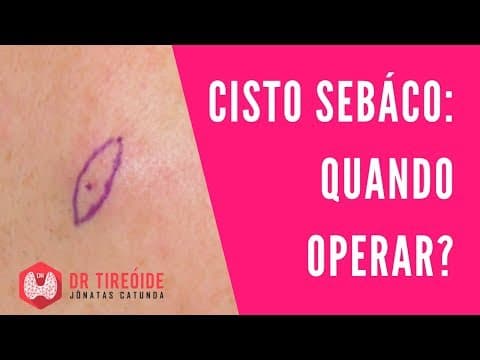 Cisto sebáceo: Quais casos terão que fazer cirurgia? Dr Jônatas Catunda