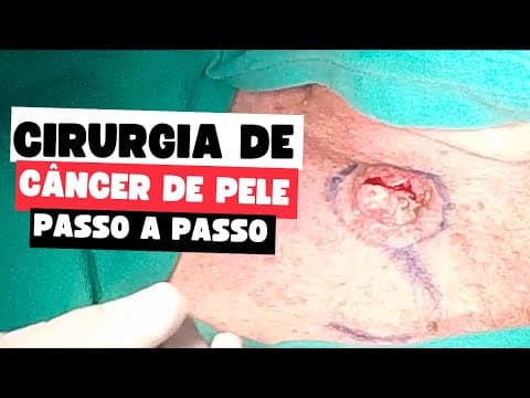 Cirurgia de câncer de pele passo a passo: remoção + reconstrução com retalho