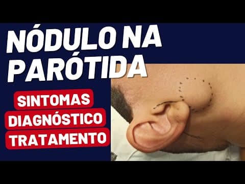 Nódulo na Parótida: Conheça as Opções de Tratamento