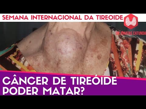 Câncer de tireoide pode matar? - Semana internacional da tireoide