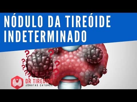 Nódulo da tireóide indeterminado - Dr Tireóide Responde