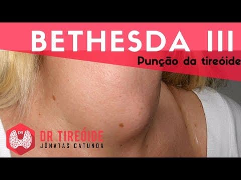 PAAF da tireóide Bethesda III - Indeterminado! | Dr Jônatas Catunda
