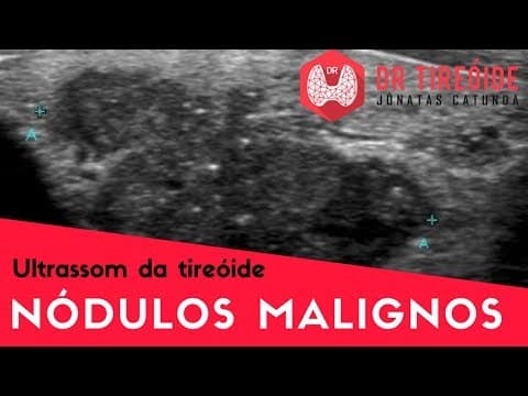 Ultrassom da tireóide - Nódulos malignos! | Dr Jônatas Catunda
