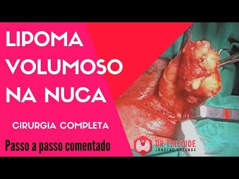 Cirurgia para retirar um lipoma volumoso - Cirurgia Passo a passo | Dr Jônatas Catunda