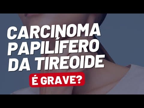 Carcinoma Papilífero de Tireoide: o Câncer Mais Comum da Tireoide!