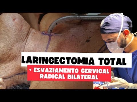 Comentários sobre câncer avançado de laringe - Laringectomia total com esvaziamento cervical radicla