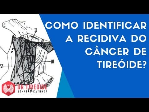 Como identificar a recidiva do câncer de tireóide? | Dr Tireóide Responde
