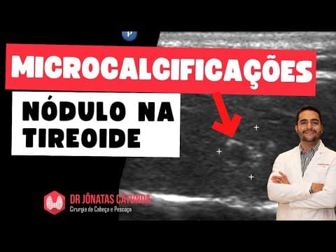 Microcalcificação em nódulo na tireoide - preocupante? Maligno?