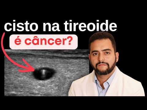 Cisto na tireoide pode virar câncer? Entenda a diferença entre cisto e nódulo