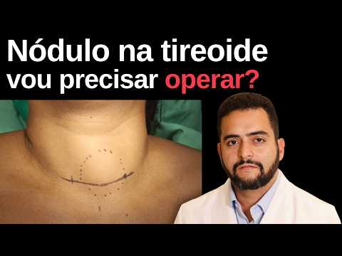 Você tem nódulo na tireoide? Veja quais casos tem indicação de cirurgia