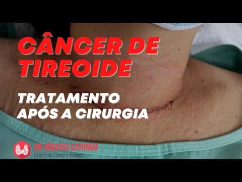 Câncer de tireoide, como é o tratamento após a cirurgia? Iodoterapia? Terapia supressiva?
