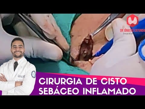 Cisto sebáceo inflamado - cirurgia filmada