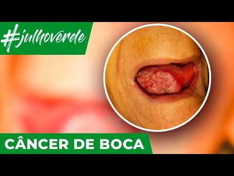 Informações importantes sobre o câncer de boca | Campanha Julho Verde