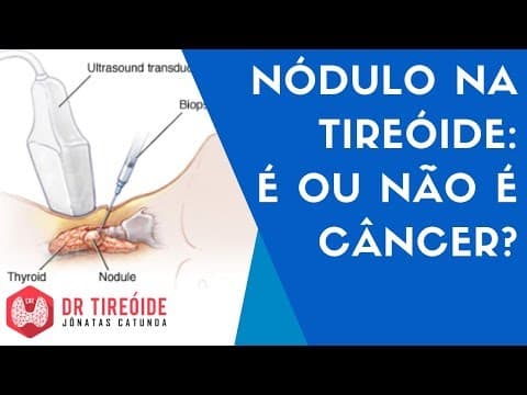 Nódulo na tireóide: é ou não é câncer? | Dr Tireóide Responde
