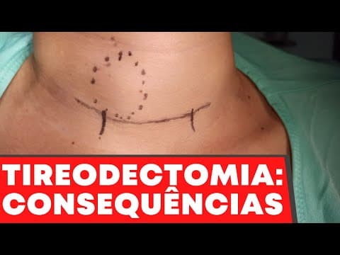 Quais as consequências da cirurgia da tireoide? | Live Dr Jônatas Catunda