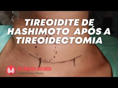 Tireoidite de Hashimoto após a cirurgia da tireoide