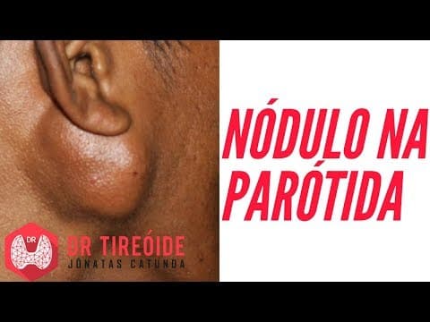Nódulo na parótida - Sintomas, Diagnóstico e Tratamento - Parotidectomia!
