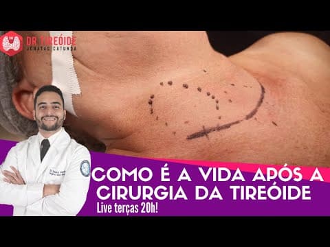 Como é a vida após a cirurgia da tireóide - LIVE Dr Tireóide responde