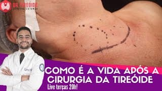 Como é a vida após a cirurgia da tireóide - LIVE Dr Tireóide responde #106#