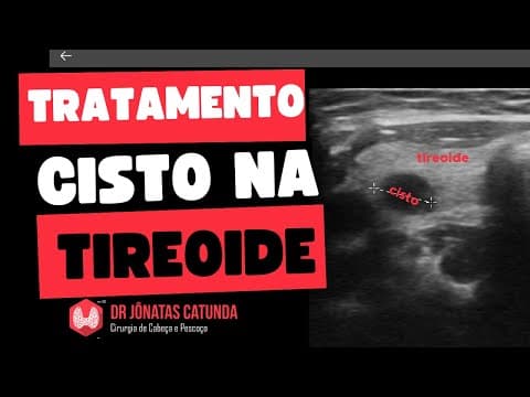 Tratamento do cisto na tireoide - Respondendo perguntas ao vivo