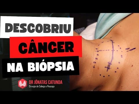 Carcinoma papilífero da tireoide descoberto após a tireoidectomia - Achado incidental de câncer