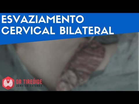 Esvaziamento cervical bilateral - Dr Tireóide Responde